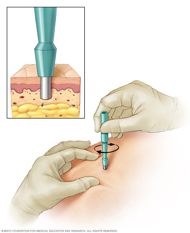 Biopsy Types Of Biopsy Procedures Used To Diagnose Cancer